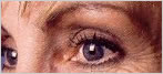 botox Leeds