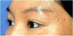 botox Leeds