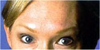 botox Leeds
