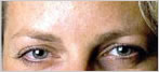 botox Leeds