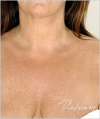 botox in Leeds