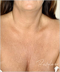 botox in Leeds