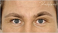Restylane Wakefield