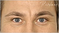 Restylane Wakefield