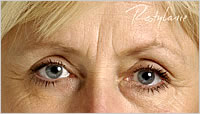 Restylane Wakefield
