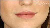 Restylane Leeds