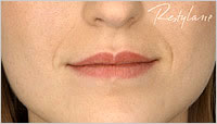 Restylane Leeds