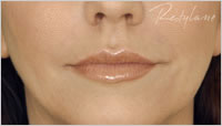 botox Leeds
