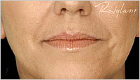 botox in  Leeds