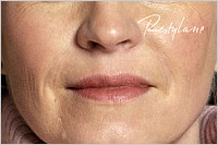 botox in  Leeds