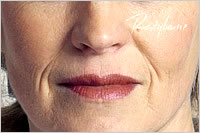 botox Leeds