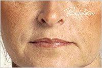 botox Leeds