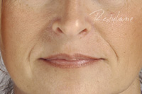 botox Leeds