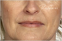 botox in Leeds
