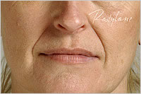 botox Leeds
