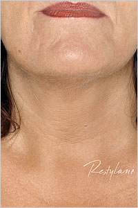 botox in Leeds