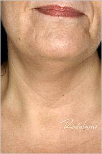 botox in Leeds