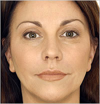 botox Leeds