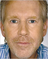 botox Leeds