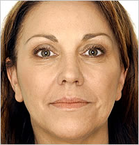 botox Leeds