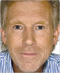 botox Leeds