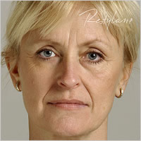 botox Leeds