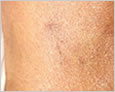 Juvederm Leeds