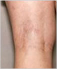 Botox Leeds