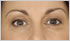 Juvederm Leeds